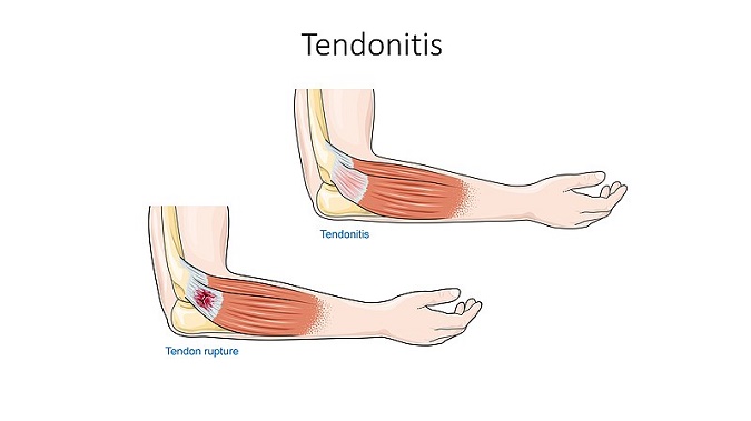 Aperçu sur 7 traitements de la tendinopathie