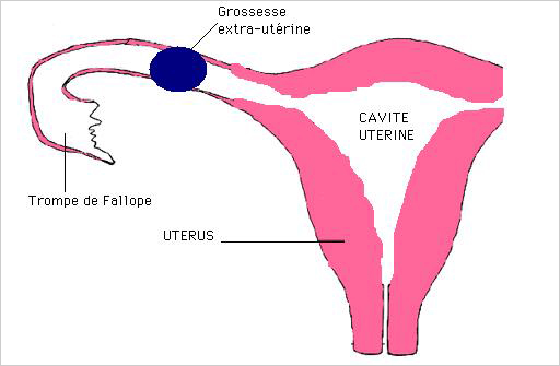 Qu'est-ce qu'une grossesse extra utérine?